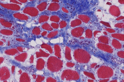 trichrome stain of aged muscle tissue